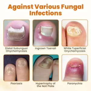 CVREOZ® FungiFix Bee Venom Nail Spray