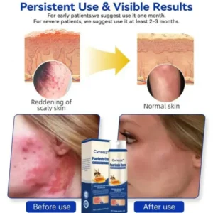 Cvreoz® Psoriasis Cure Bee Venom Treatment Spray