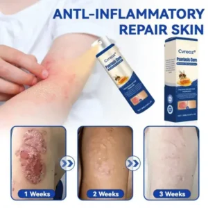 Cvreoz® Psoriasis Cure Bee Venom Treatment Spray