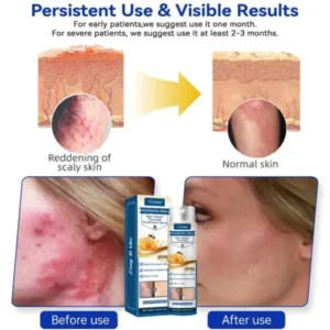 Cvreoz® Psoriasis Heal Bee Venom Spray