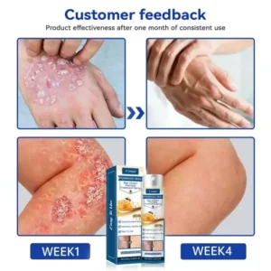 Cvreoz® Psoriasis Heal Bee Venom Spray