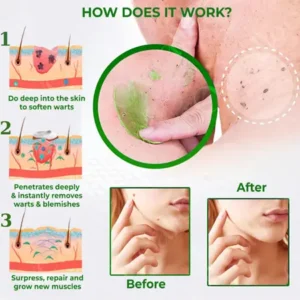 Cvreoz® Natural Spot and Mole removal cream