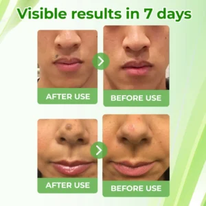 Cvreoz® Natural Spot and Mole removal cream