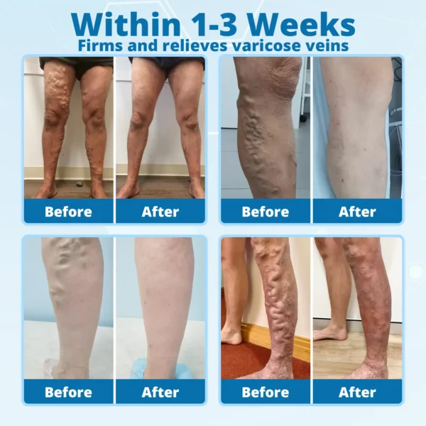 Cvreoz® VeinErase MicroNeedle Repair Patch