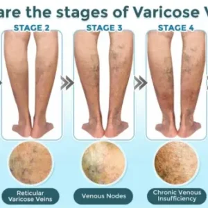 Cvreoz® VenaRestore MicroNeedle Vein Repair Patch